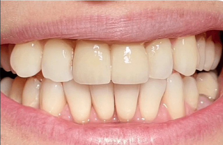 2-Front-Crowns-After-Image