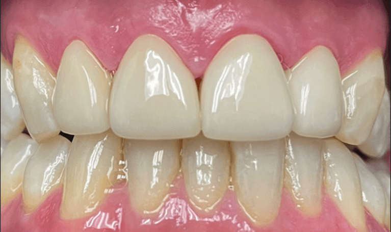 4-Front-Crowns-Makeover-After-Image