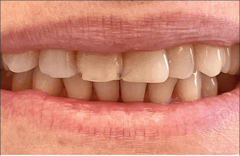 2-Front-Crowns-Before-Image