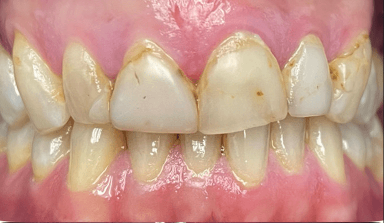 4-Front-Crowns-Makeover-Before-Image